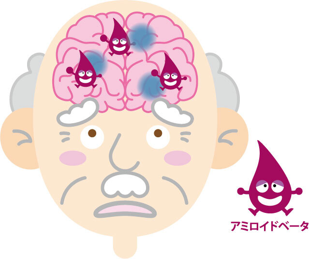 アミロイドβのイラスト